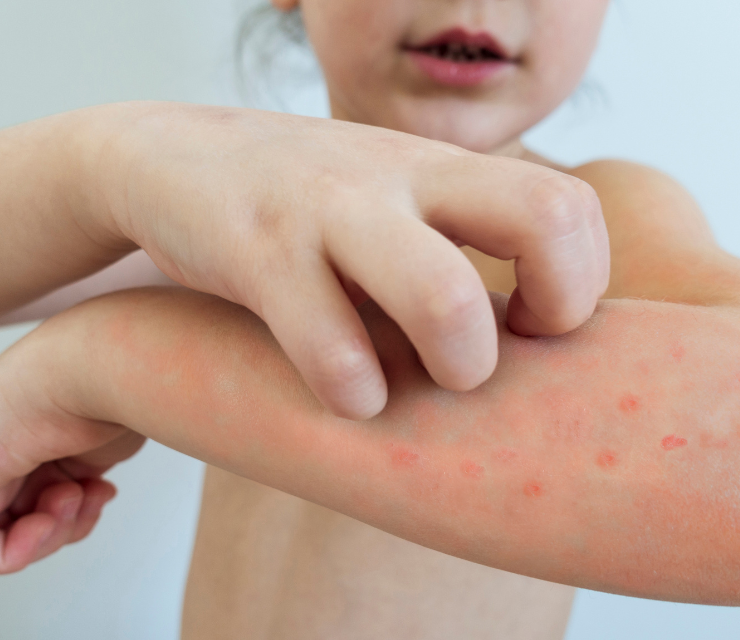 Protect your child from the discomfort of chickenpox with an effective vaccination service